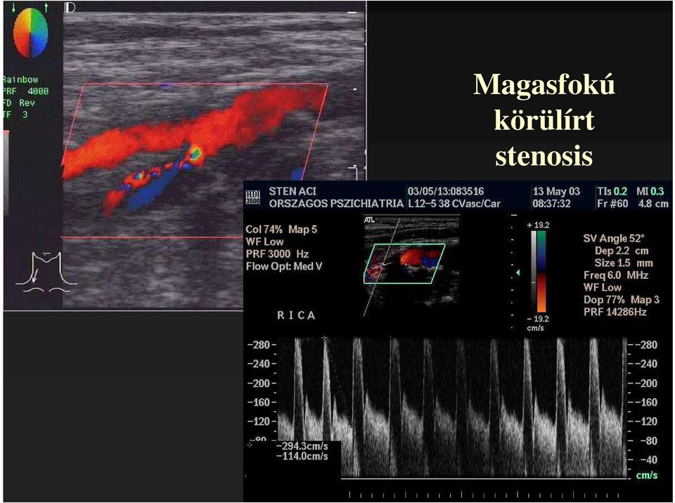 stenosis