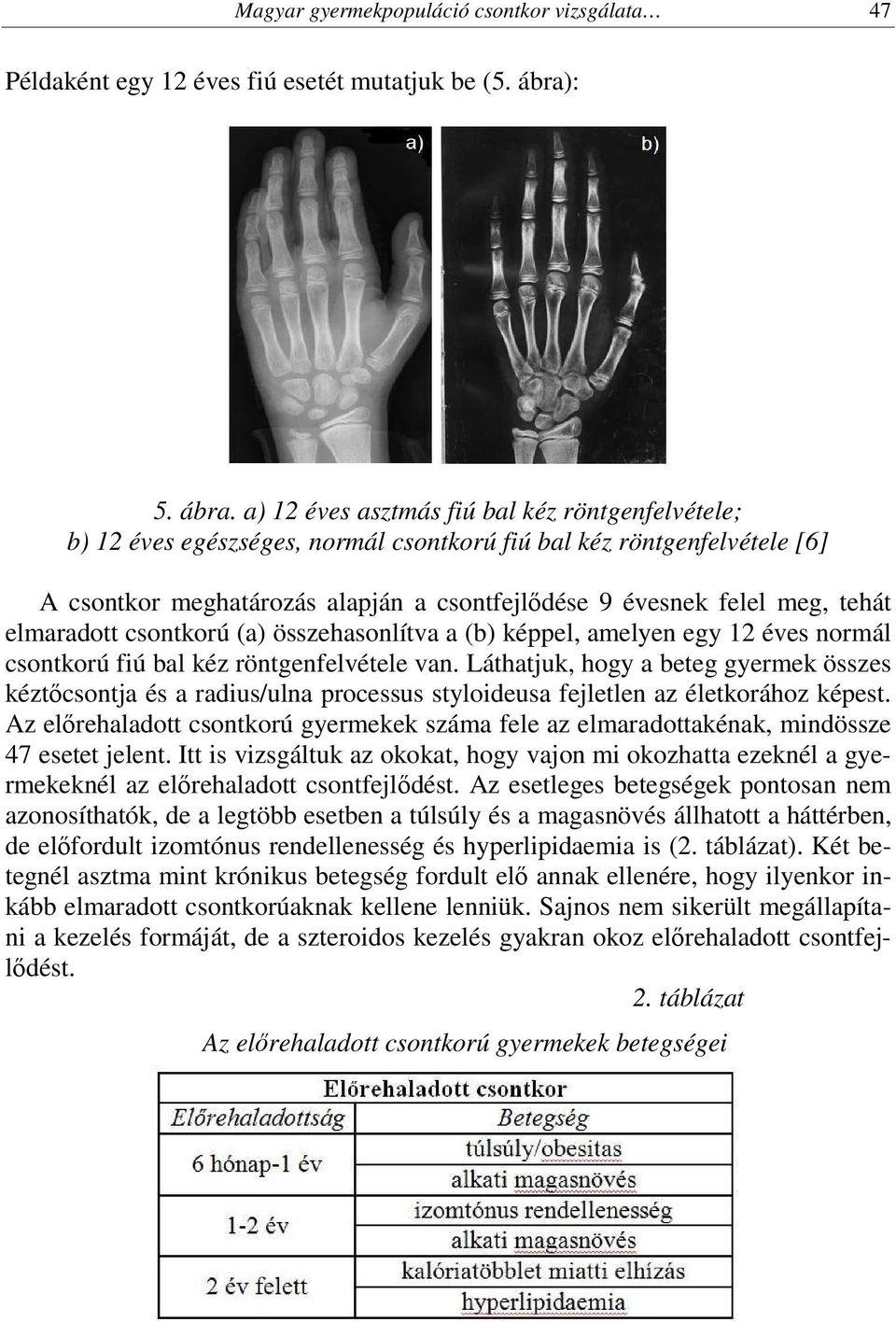 a) 12 éves asztmás fiú bal kéz röntgenfelvétele; b) 12 éves egészséges, normál csontkorú fiú bal kéz röntgenfelvétele [6] A csontkor meghatározás alapján a csontfejlődése 9 évesnek felel meg, tehát