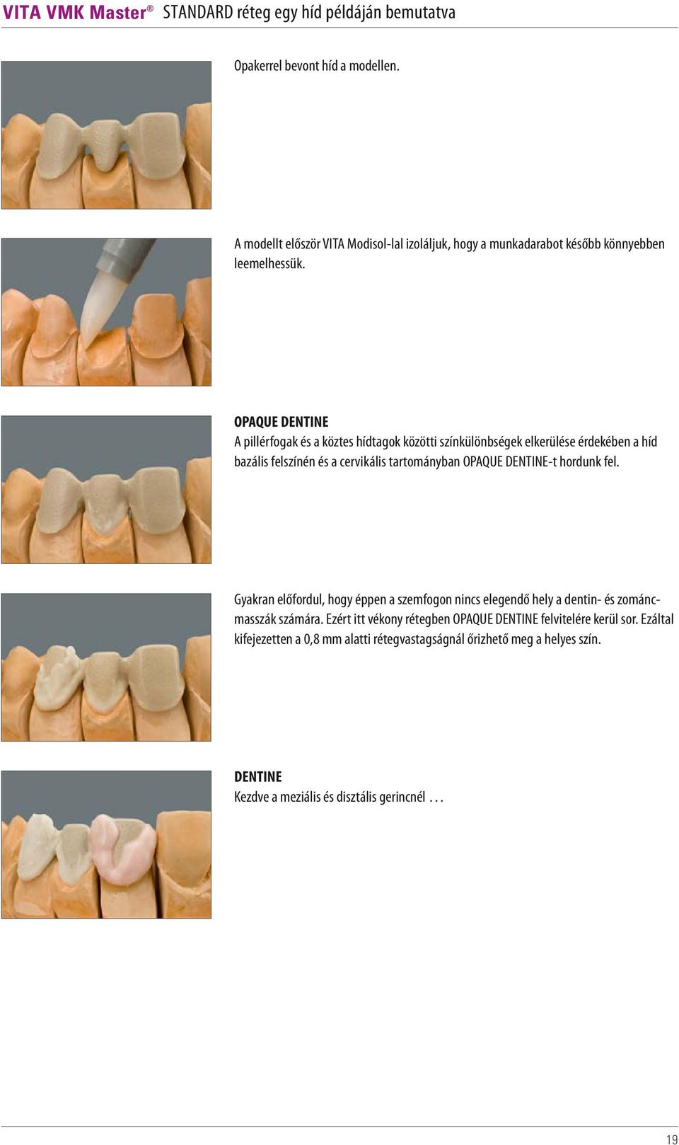 OPAQUE DENTINE A pillérfogak és a köztes hídtagok közötti színkülönbségek elkerülése érdekében a híd bazális felszínén és a cervikális tartományban OPAQUE