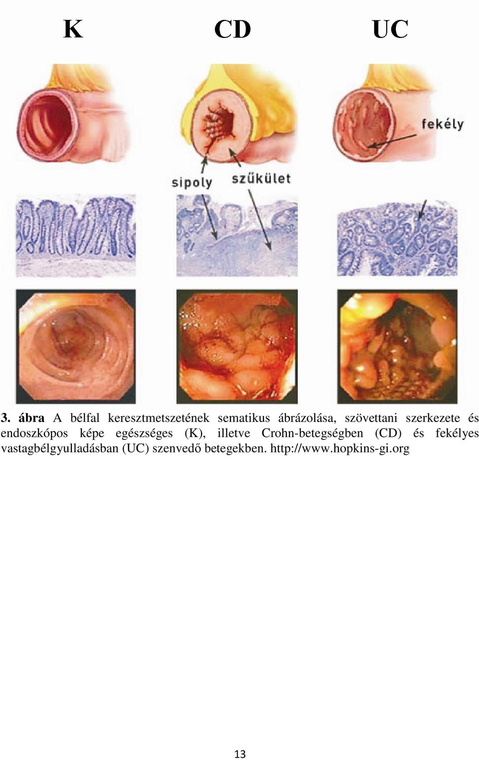 illetve Crohn-betegségben (CD) és fekélyes
