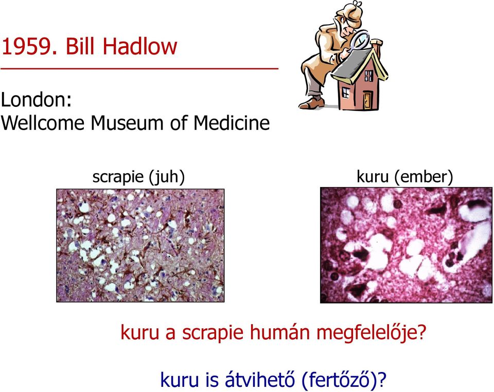 kuru (ember) kuru a scrapie humán