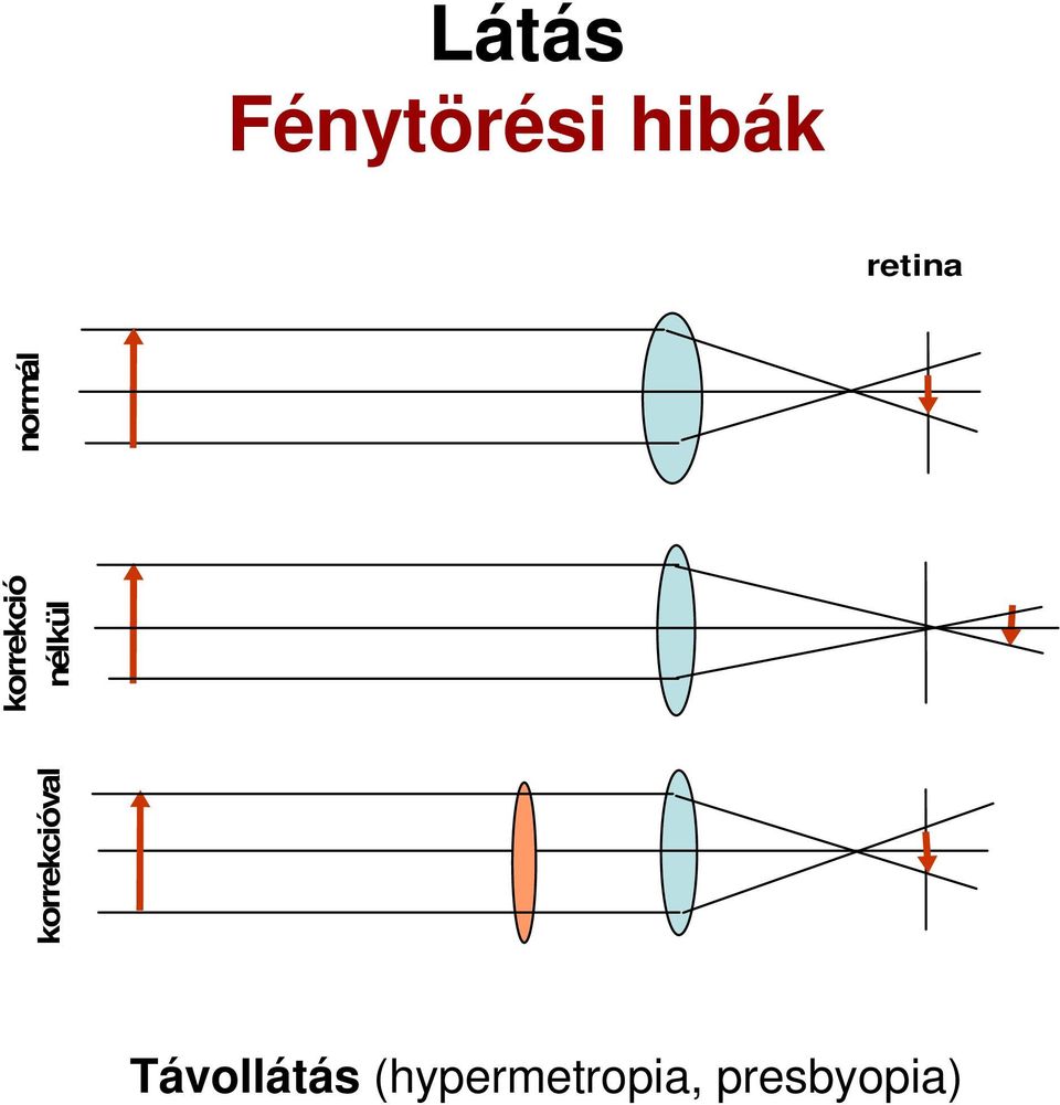 (hypermetropia,