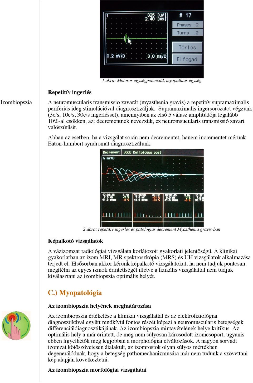 . Supramaximalis ingersorozatot végzünk (3c/s, 10c/s, 30c/s ingerléssel), amennyiben az első 5 válasz amplitúdója legalább 10%-al csökken, azt decrementnek nevezzük, ez neuromsucularis transmissió