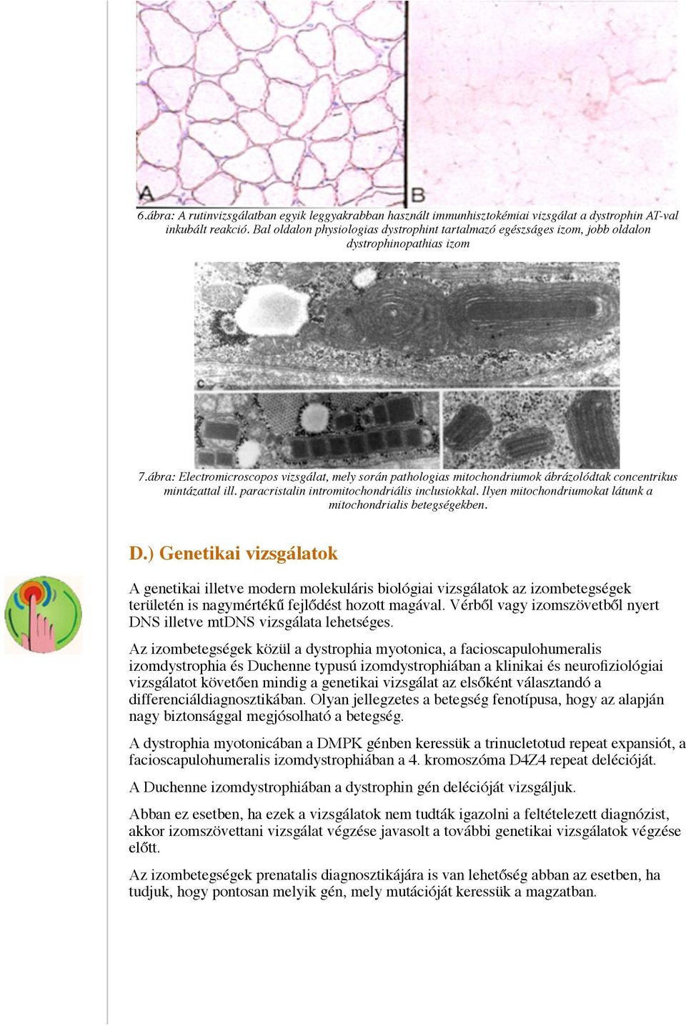 ábra: Electromicroscopos vizsgálat, mely során pathologias mitochondriumok ábrázolódtak concentrikus mintázattal ill. paracristalin intromitochondriális inclusiokkal.