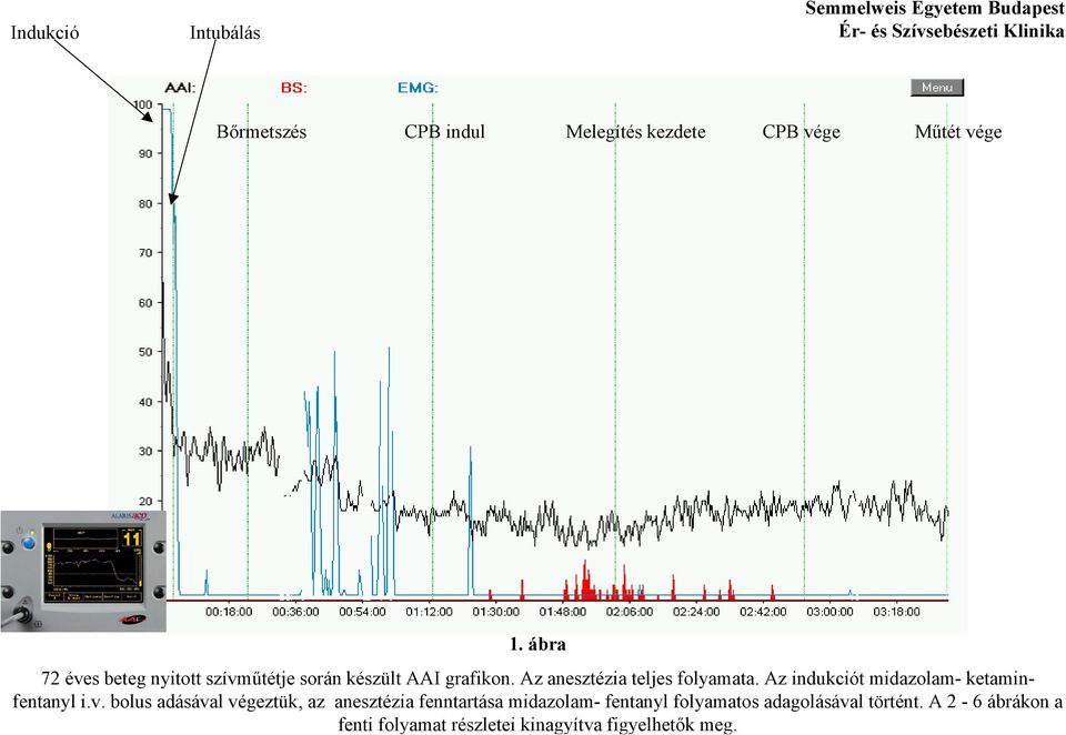 Az indukciót midazolam- ketaminfentanyl i.v.