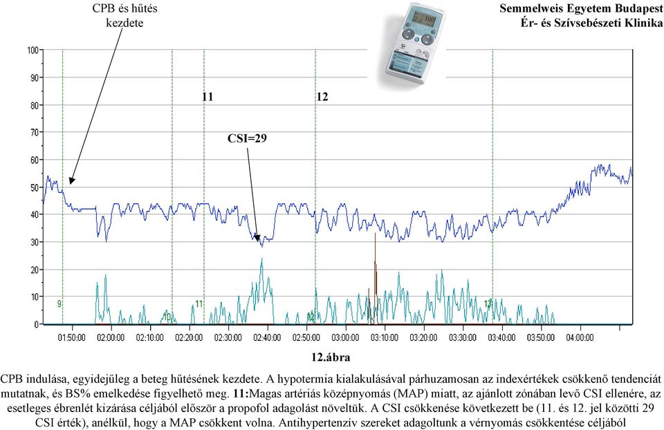 11:Magas artériás középnyomás (MAP) miatt, az ajánlott zónában levő CSI ellenére, az esetleges ébrenlét kizárása céljából először a propofol