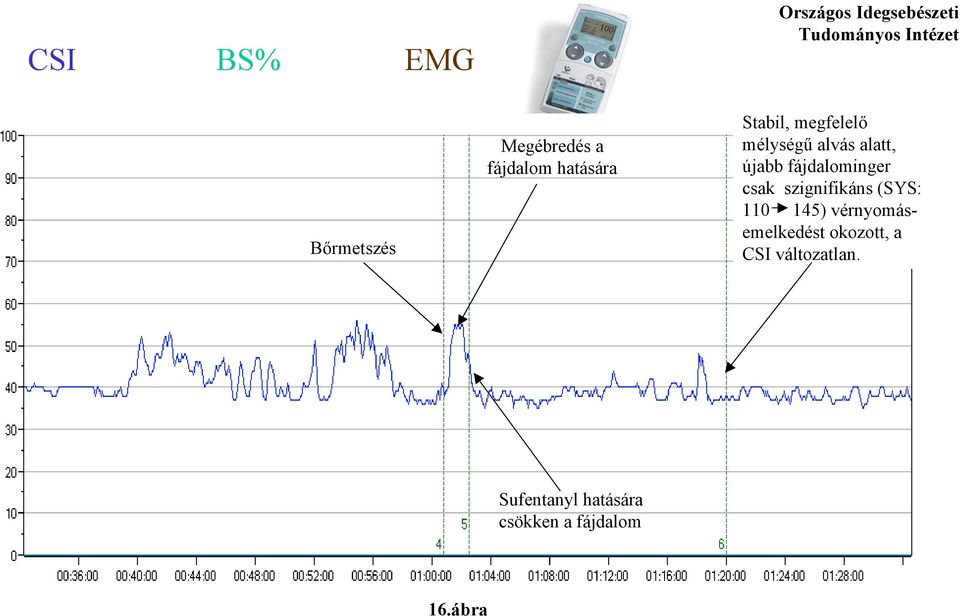 újabb fájdalominger csak szignifikáns (SYS: 110 145)