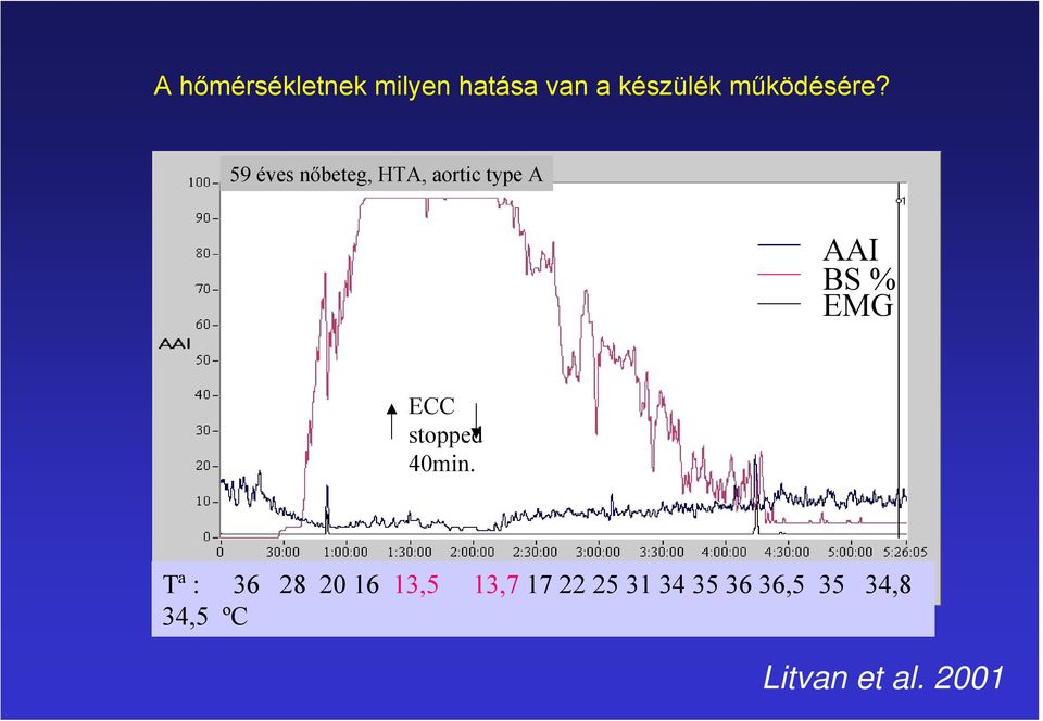 59 éves nőbeteg, HTA, aortic type A AAI BS % EMG ECC