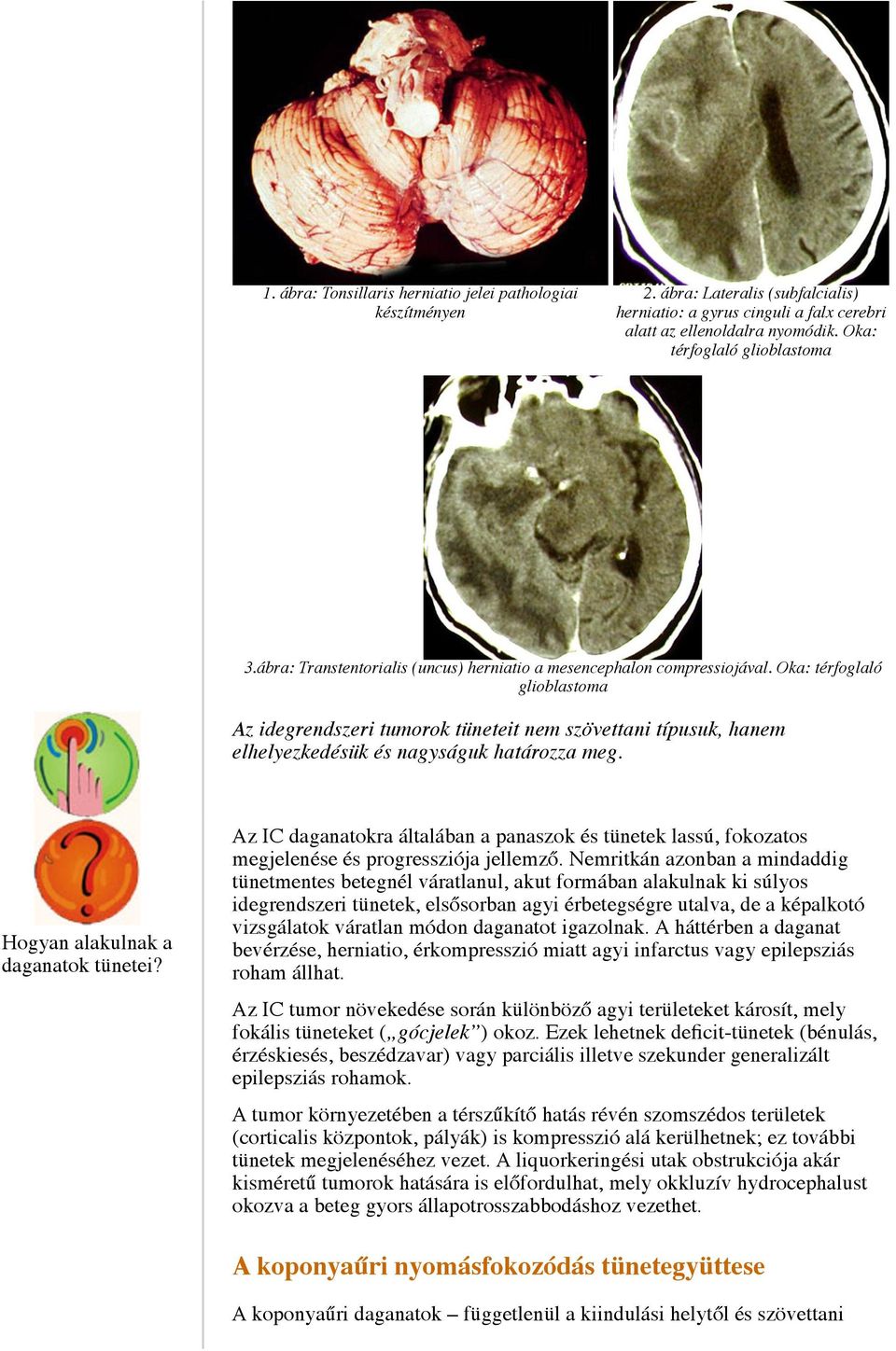 Oka: térfoglaló glioblastoma Az idegrendszeri tumorok tüneteit nem szövettani típusuk, hanem elhelyezkedésük és nagyságuk határozza meg. Hogyan alakulnak a daganatok tünetei?