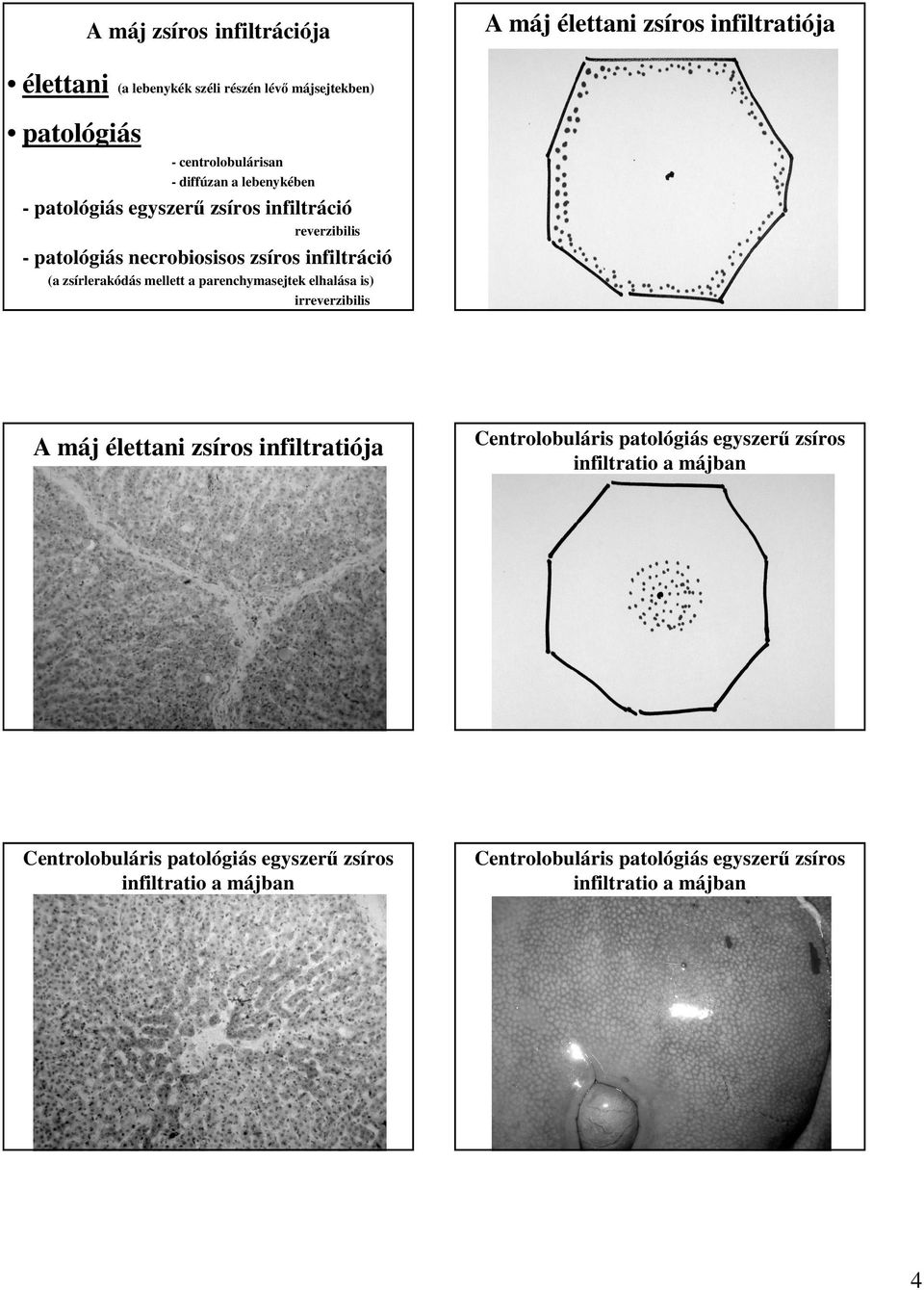 infiltráció (a zsírlerakódás mellett a parenchymasejtek elhalása is) irreverzibilis A máj élettani zsíros infiltratiója Centrolobuláris