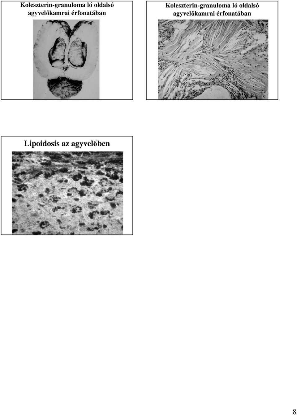 Lipoidosis az agyvelıben 8