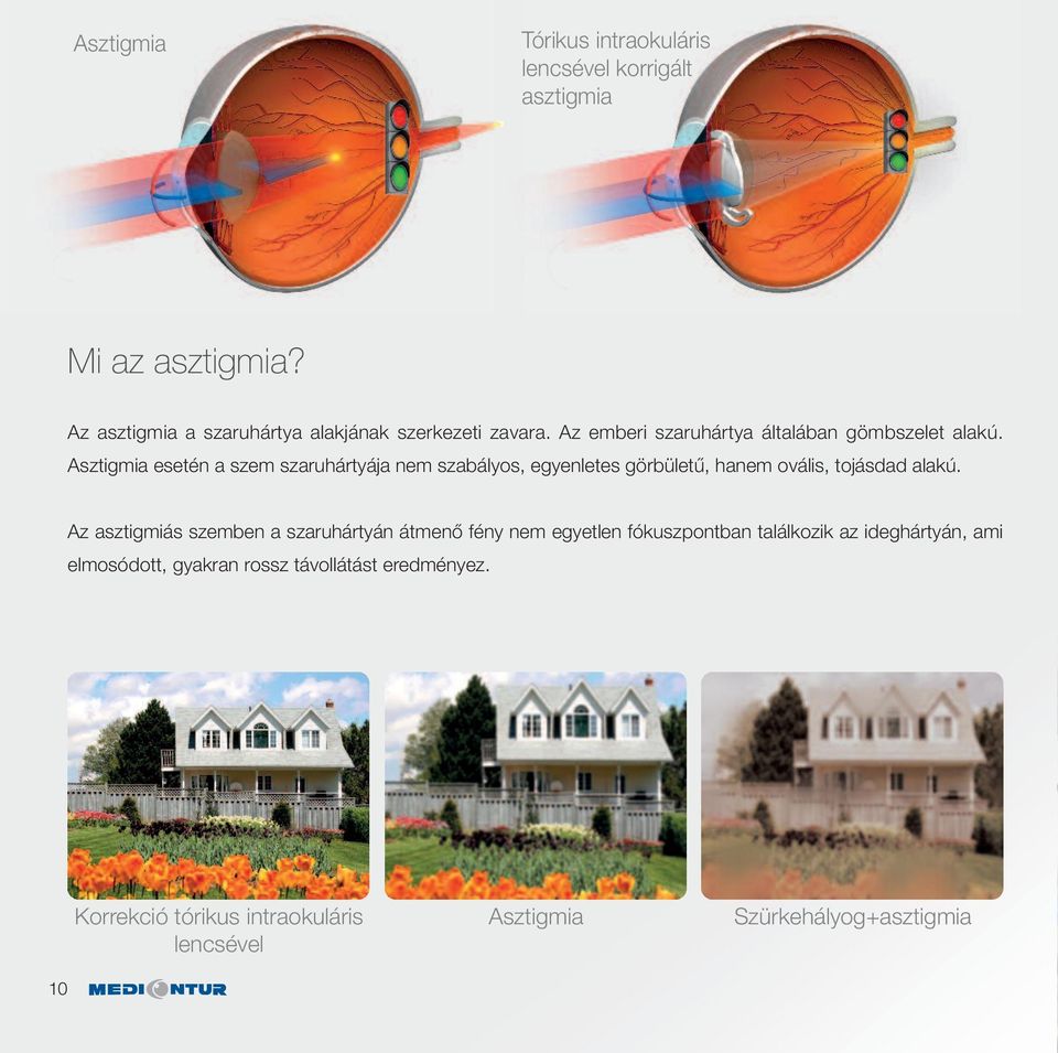 Asztigmia esetén a szem szaruhártyája nem szabályos, egyenletes görbületű, hanem ovális, tojásdad alakú.