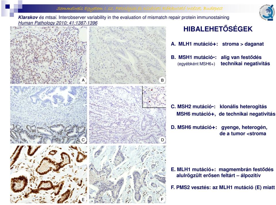 HIBALEHETŐSÉGEK A. MLH1 mutáció: stroma > daganat B. MSH1 mutáció-: alig van festődés (egyébként MSH6) technikai negativitás C.