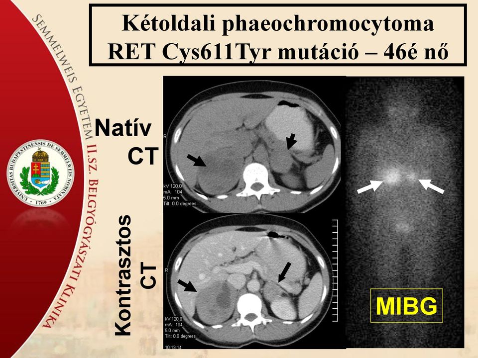 phaeochromocytoma RET