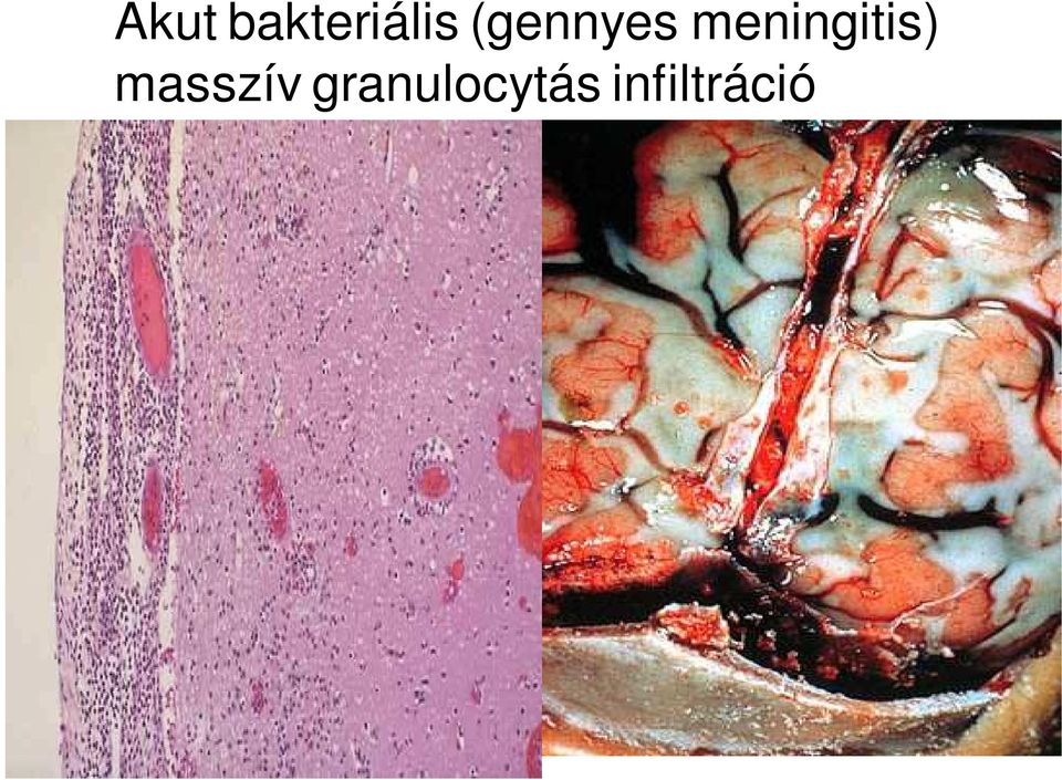 meningitis)