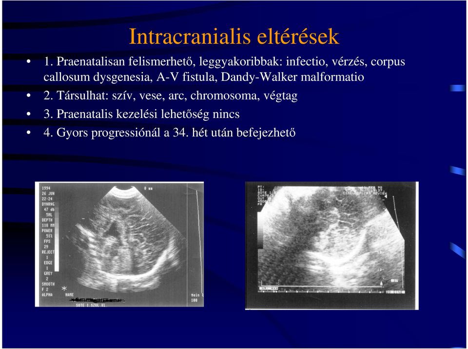 callosum dysgenesia, A-V fistula, Dandy-Walker malformatio 2.