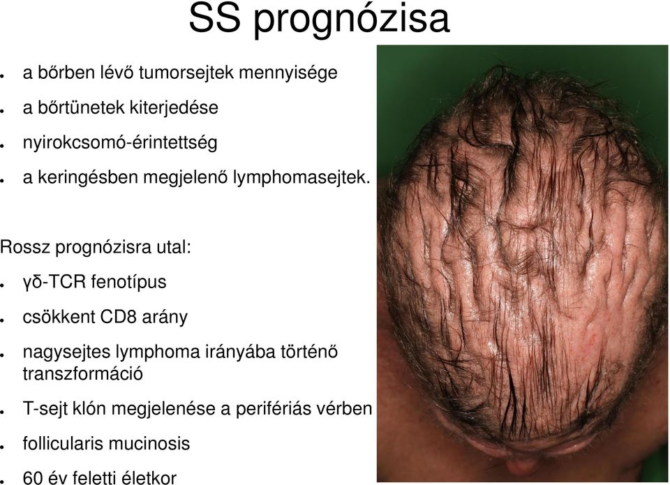 Rossz prognózisra utal: γδ-tcr fenotípus csökkent CD8 arány nagysejtes lymphoma