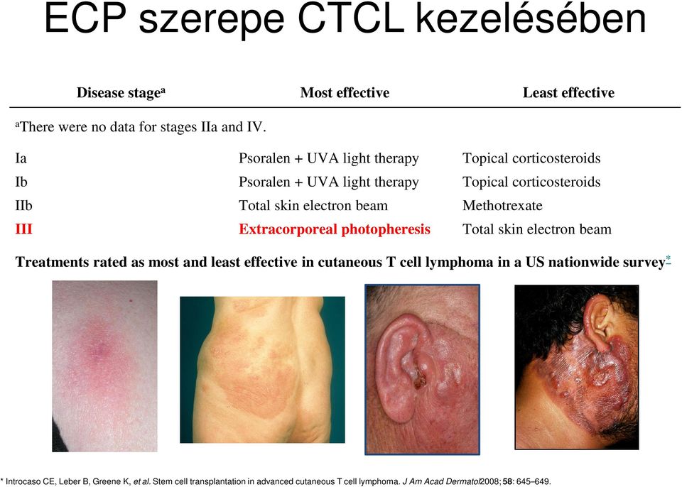 Methotrexate III Extracorporeal photopheresis Total skin electron beam Treatments rated as most and least effective in cutaneous T cell lymphoma