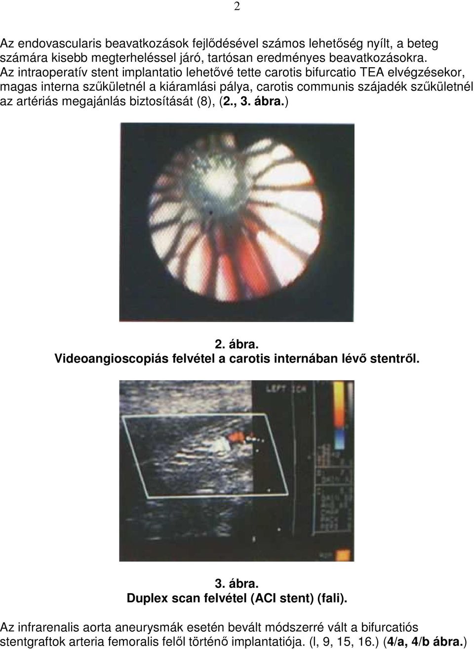 szőkületnél az artériás megajánlás biztosítását (8), (2., 3. ábra.) 2. ábra. Videoangioscopiás felvétel a carotis internában lévı stentrıl. 3. ábra. Duplex scan felvétel (ACI stent) (fali).