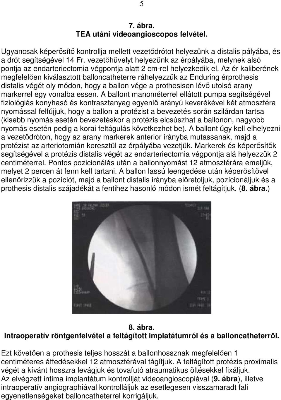 Az ér kaliberének megfelelıen kiválasztott balloncatheterre ráhelyezzük az Enduring érprothesis distalis végét oly módon, hogy a ballon vége a prothesisen lévı utolsó arany markerrel egy vonalba