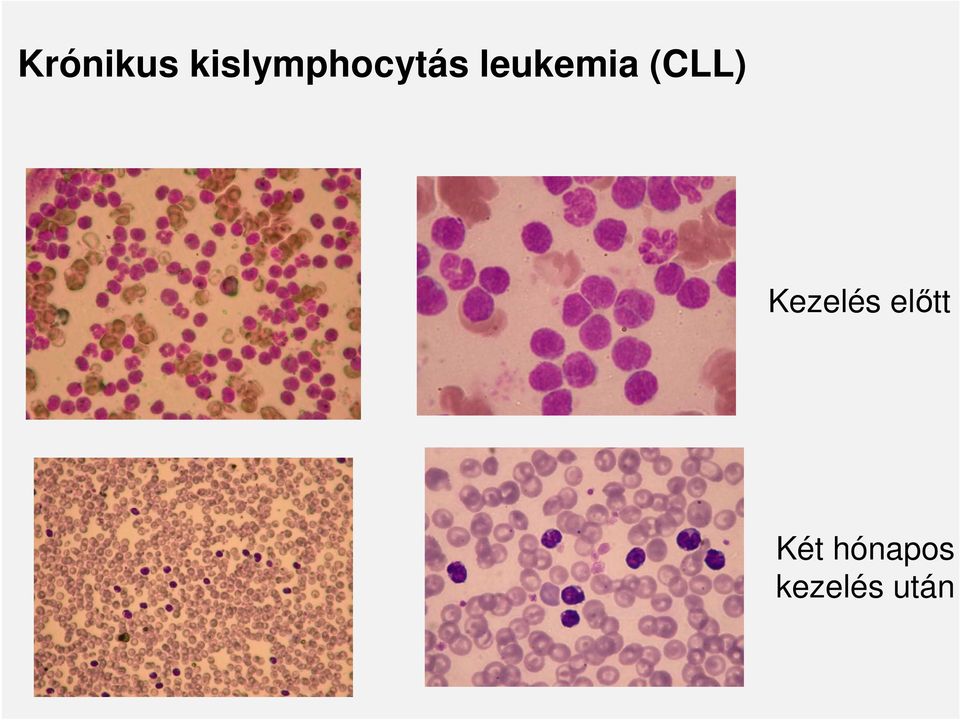 leukemia (CLL)