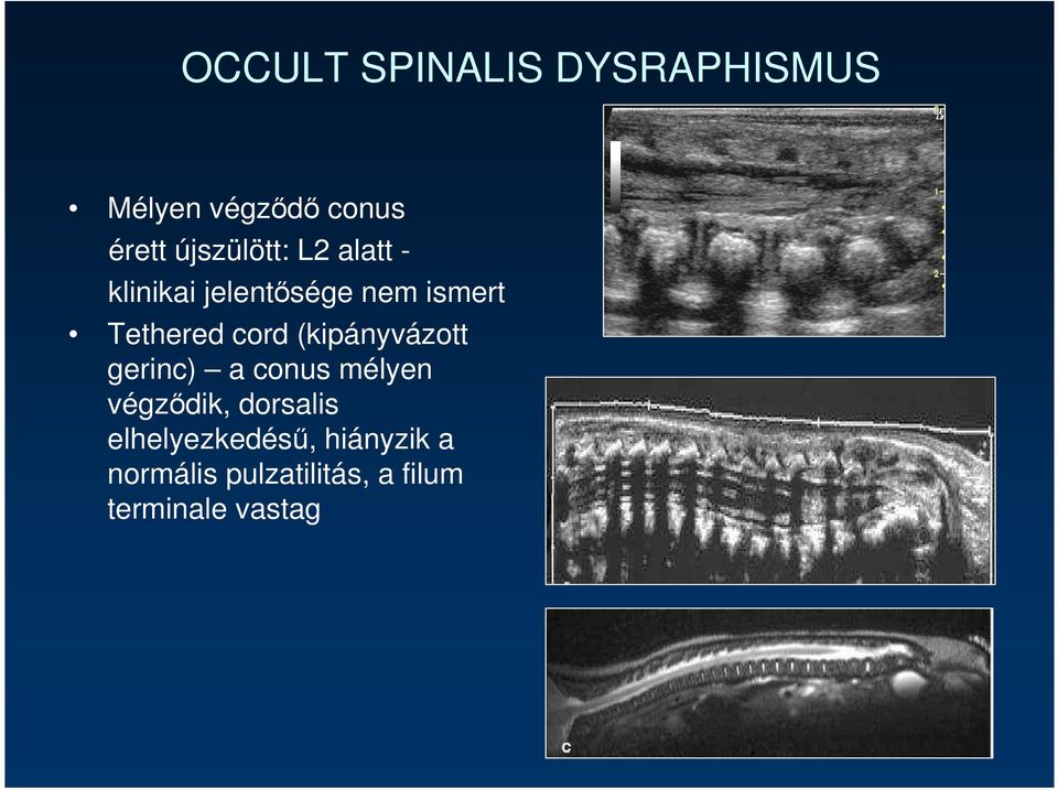 cord (kipányvázott gerinc) a conus mélyen végzıdik, dorsalis