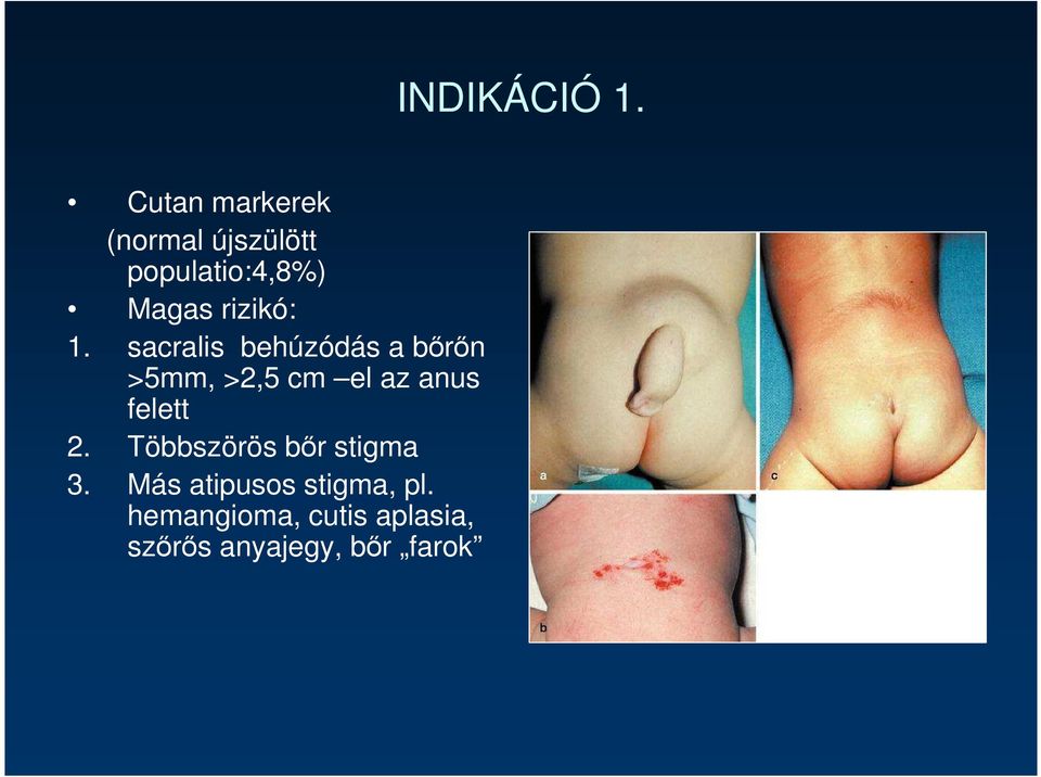 sacralis behúzódás a bırın >5mm, >2,5 cm el az anus felett 2.