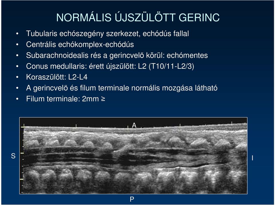 echómentes Conus medullaris: érett újszülött: L2 (T10/11-L2/3) Koraszülött: