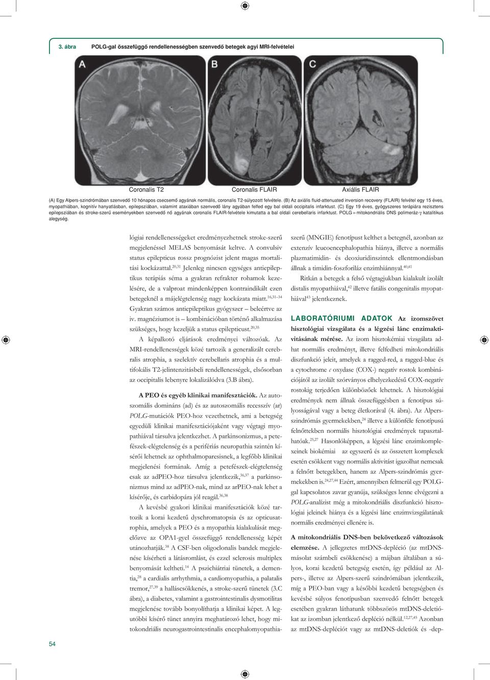 (B) Az axiális fluid-attenuated inversion recovery (FLAIR) felvétel egy 15 éves, myopathiában, kognitív hanyatlásban, epilepsziában, valamint ataxiában szenvedô lány agyában felfed egy bal oldali