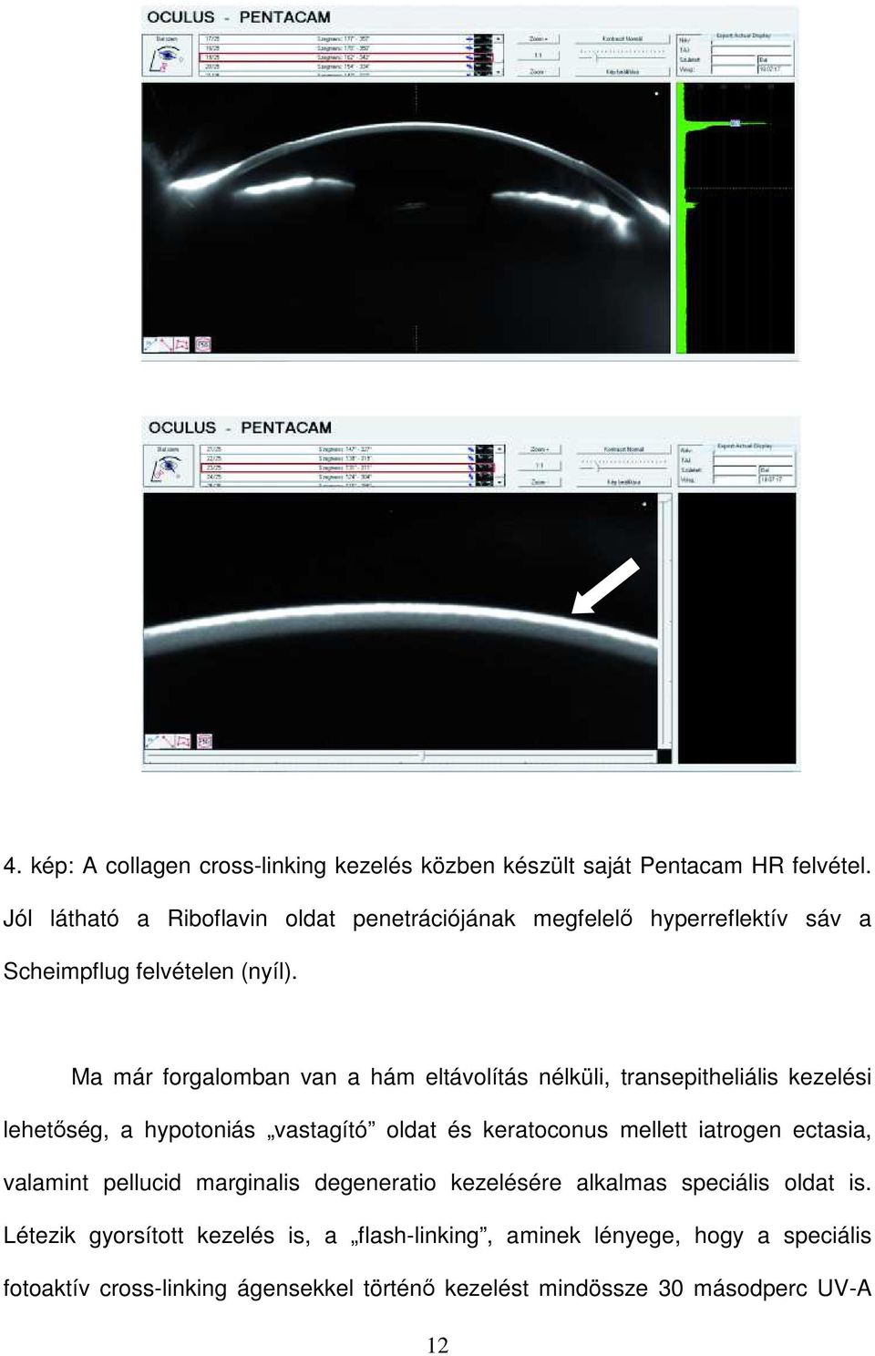 Ma már forgalomban van a hám eltávolítás nélküli, transepitheliális kezelési lehetőség, a hypotoniás vastagító oldat és keratoconus mellett iatrogen