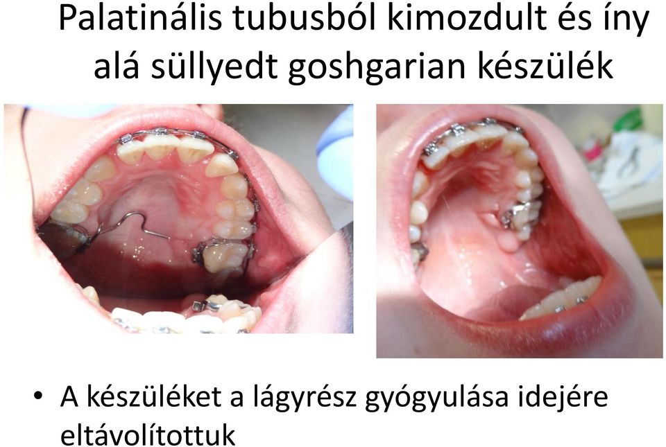 készülék A készüléket a