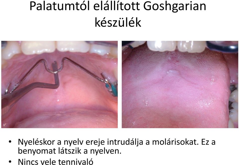 intrudálja a molárisokat.