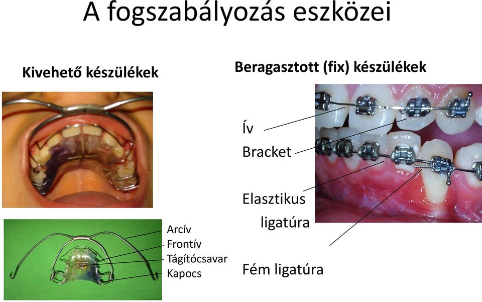 készülékek Ív Bracket Arcív Frontív