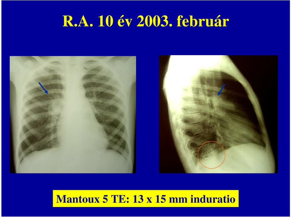 Mantoux 5 TE: