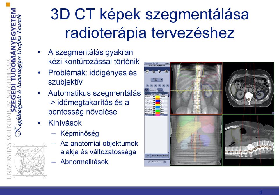 Automatikus szegmentálás -> időmegtakarítás és a pontosság növelése