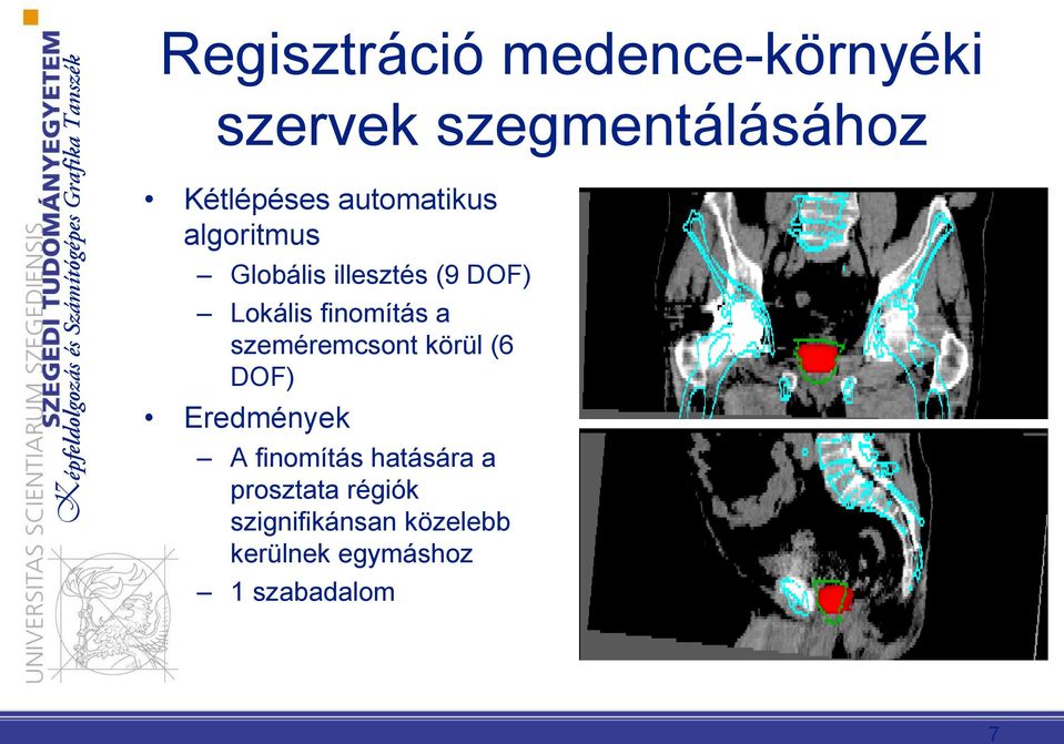 a szeméremcsont körül (6 DOF) Eredmények A finomítás hatására a