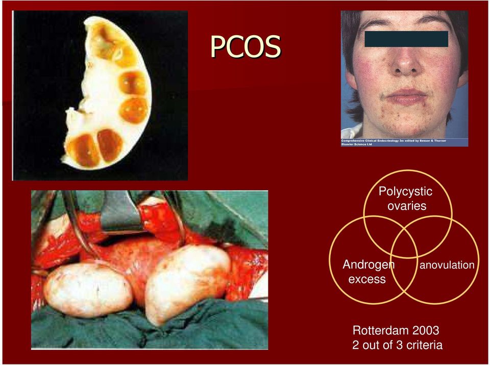 excess anovulation