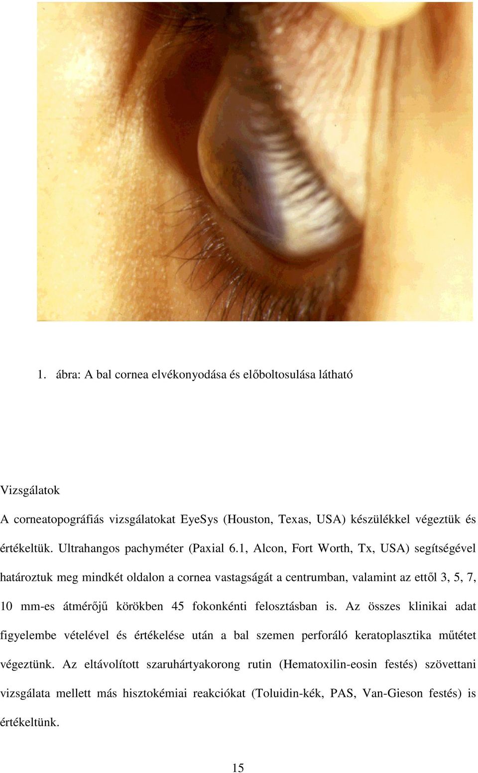 1, Alcon, Fort Worth, Tx, USA) segítségével határoztuk meg mindkét oldalon a cornea vastagságát a centrumban, valamint az ettıl 3, 5, 7, 10 mm-es átmérıjő körökben 45