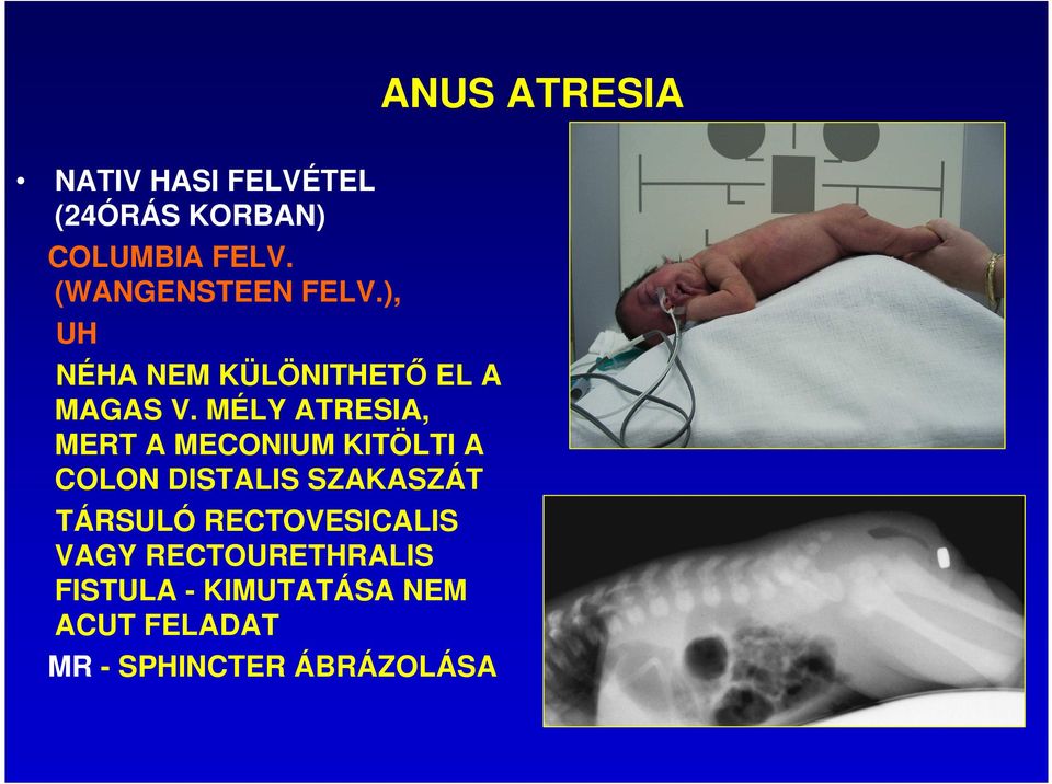 MÉLY ATRESIA, MERT A MECONIUM KITÖLTI A COLON DISTALIS SZAKASZÁT TÁRSULÓ