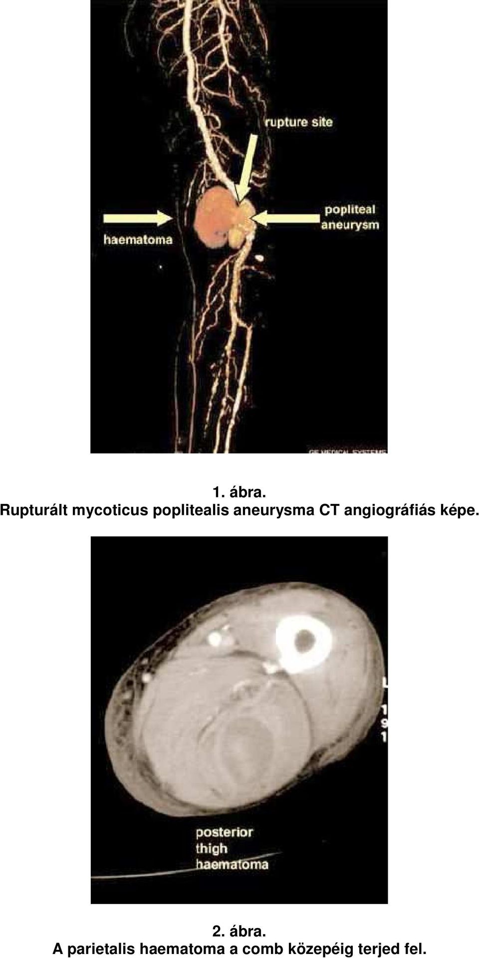 aneurysma CT angiográfiás képe. 2.