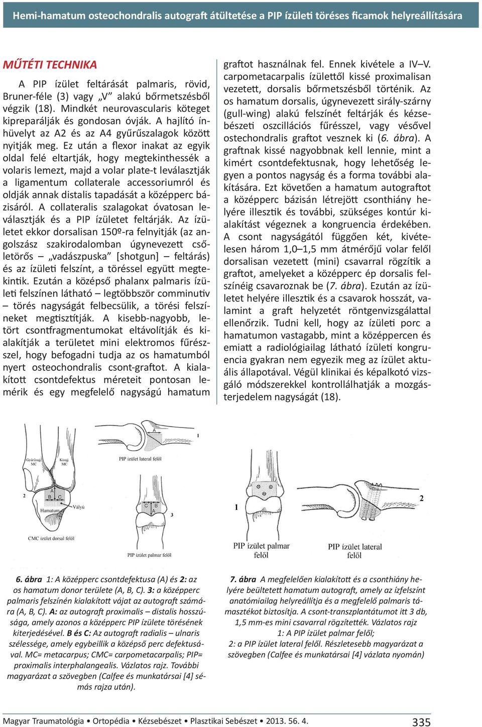 Ez után a flexor inakat az egyik oldal felé eltartják, hogy megtekinthessék a volaris lemezt, majd a volar plate-t leválasztják a ligamentum collaterale accessoriumról és oldják annak distalis