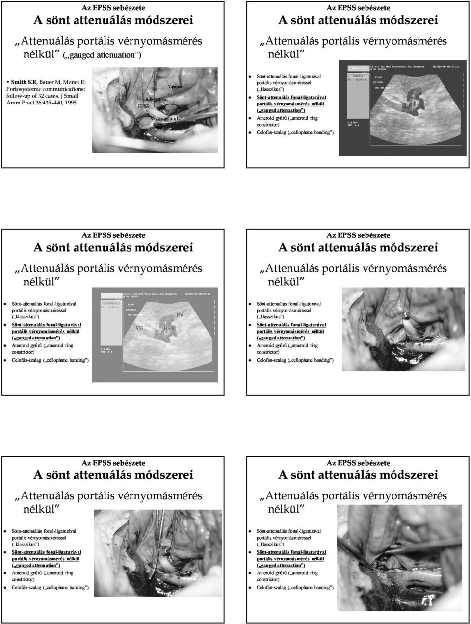 Sönt-attenuálás fonal- portális vérnyomásméréssel ( klasszikus ) Sönt-attenuálás fonal- portális vérnyomásmérés nélkül ( gauged attenuation ) Ameroid gyűrű ( ameroid ring constrictor) Celofán-szalag