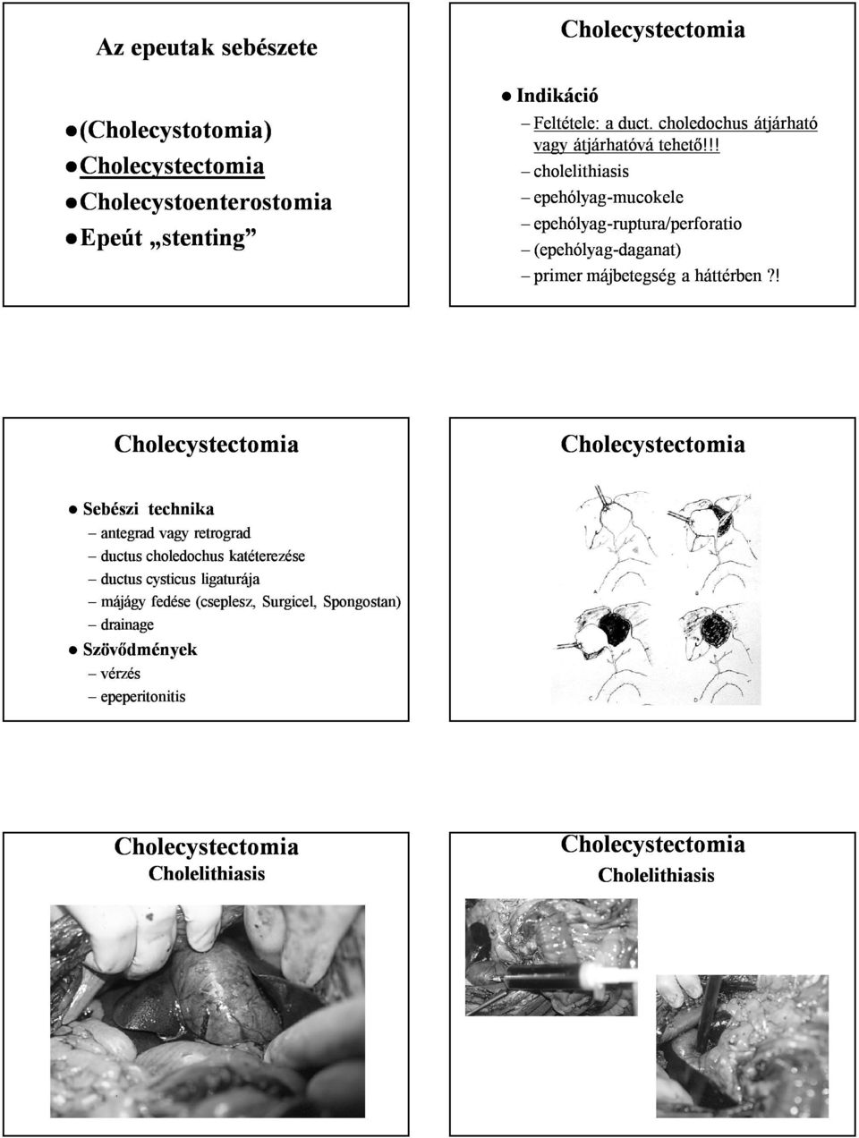 !! cholelithiasis epehólyag-mucokele epehólyag-ruptura ruptura/perforatio perforatio (epehólyag-daganat) primer