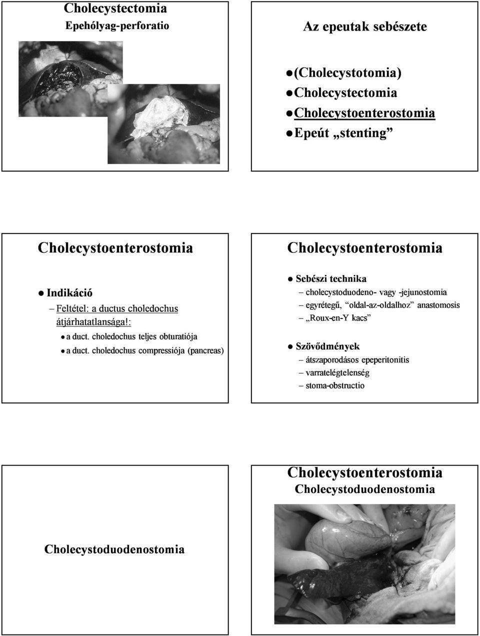 choledochus compressiója (pancreas) Sebészi technika cholecystoduodeno- vagy -jejunostomia egyrétegű,