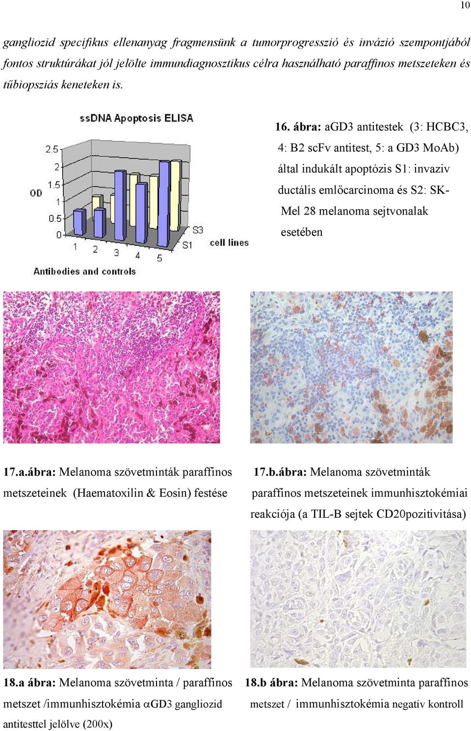 b.ábra: Melanoma szövetminták paraffinos metszeteinek immunhisztokémiai reakciója (a TIL-B sejtek CD20pozitivitása) 18.a ábra: Melanoma szövetminta / paraffinos 18.