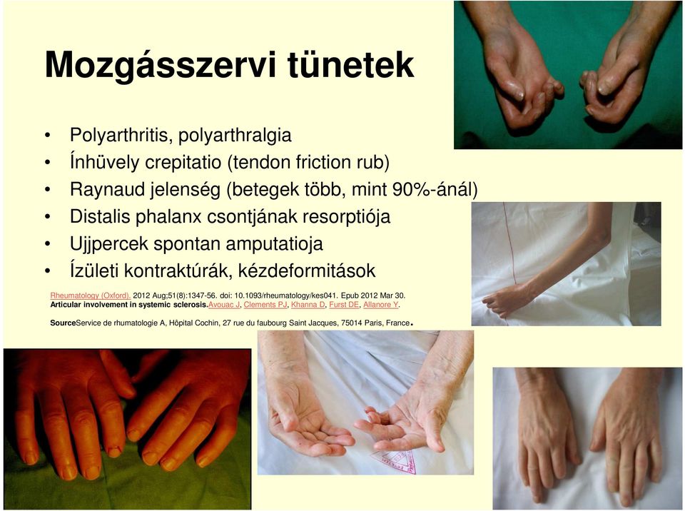 (Oxford). 2012 Aug;51(8):1347-56. doi: 10.1093/rheumatology/kes041. Epub 2012 Mar 30. Articular involvement in systemic sclerosis.