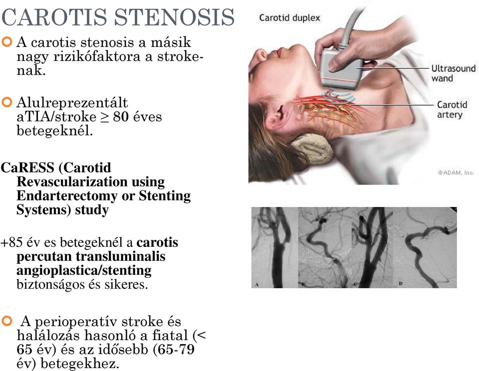 CaRESS (Carotid Revascularization using Endarterectomy or Stenting Systems) study +85 év es