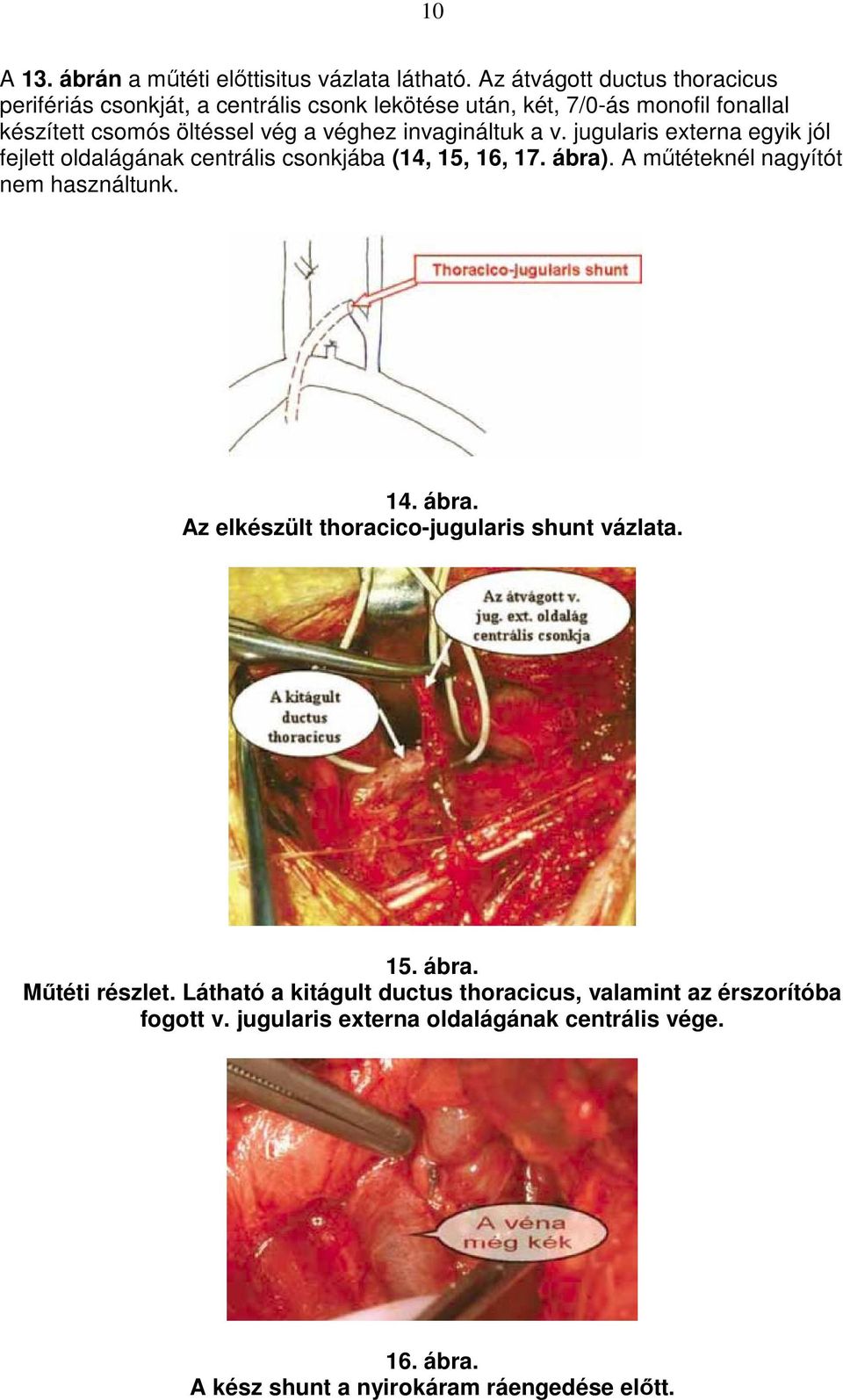 invagináltuk a v. jugularis externa egyik jól fejlett oldalágának centrális csonkjába (14, 15, 16, 17. ábra). A mőtéteknél nagyítót nem használtunk. 14.