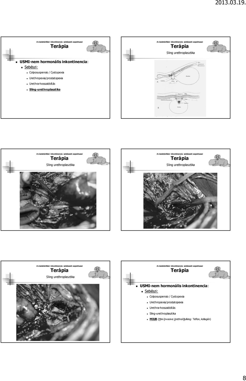 Sling-urethroplasztika MIUB (Mini-Invasive UrethralBulking: Teflon,