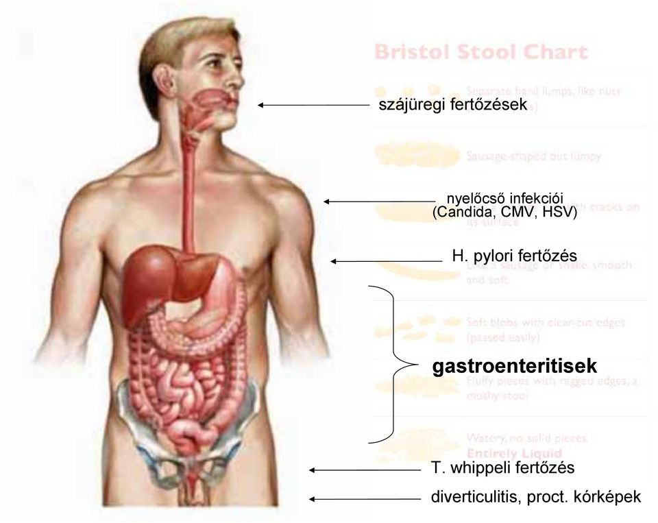 pylori fertőzés gastroenteritisek T.